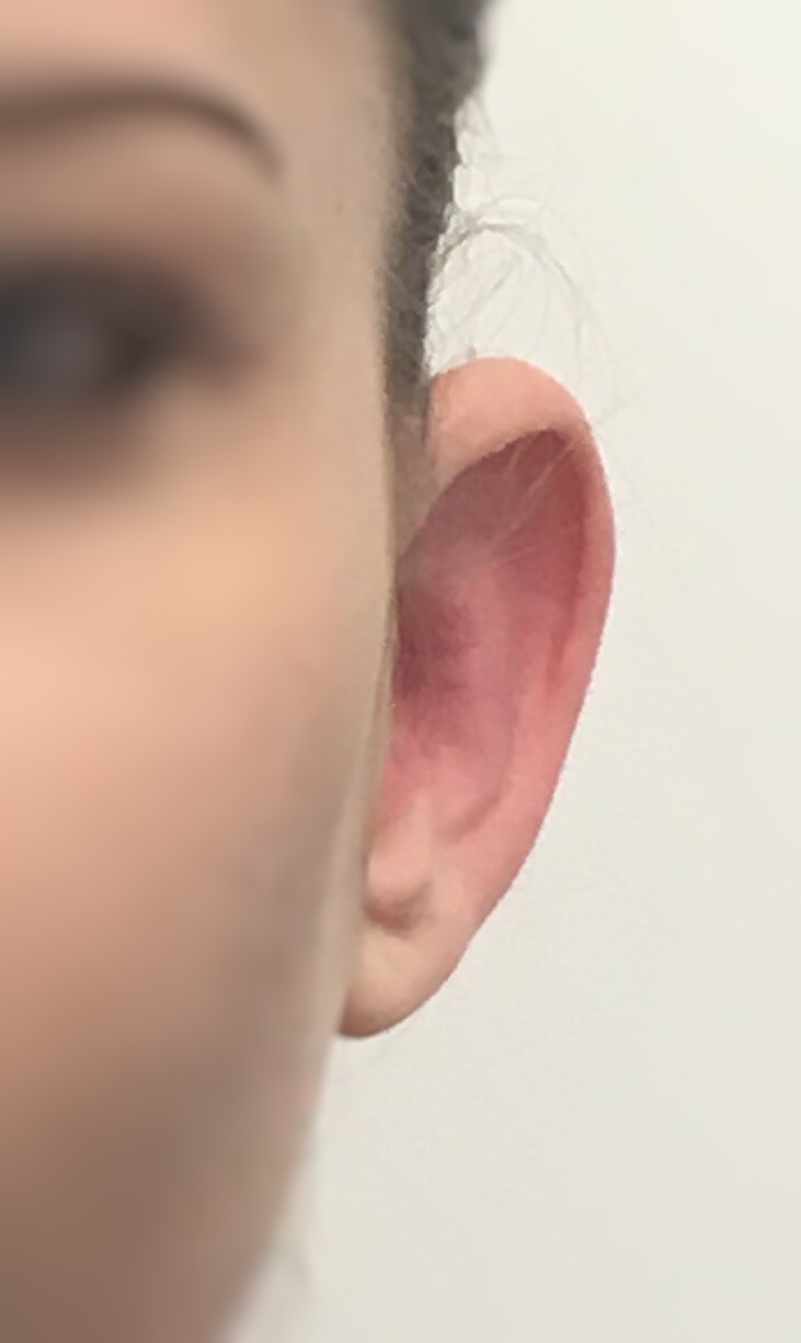 Photo avant otoplastie EarFold - Dr Mahdyoun