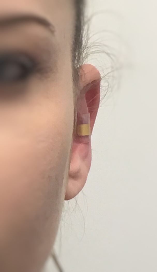 Simulation avant otoplastie EarFold - Dr Mahdyoun